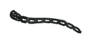 TM Bauer’s Synthes Дистальна ключична пластина, ліва